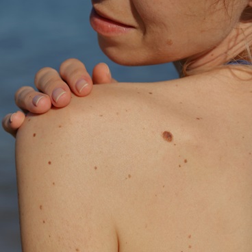 Woman checking her moles for melanoma.