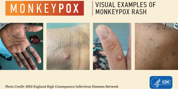 Explainer: What to Know About Monkeypox - Visual Capitalist