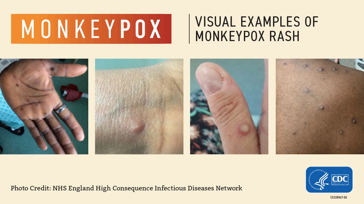 A CDC graphic showing images of monkeypox